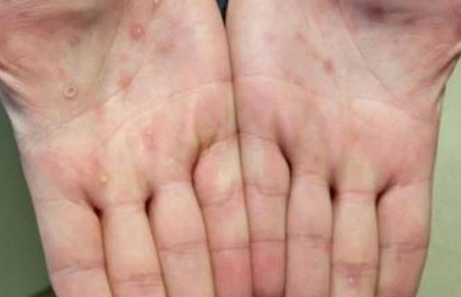 This image of lesions on hands is more representative of what the current monkeypox outbreak looks like, according to health officials. Photo: Courtesy CDC