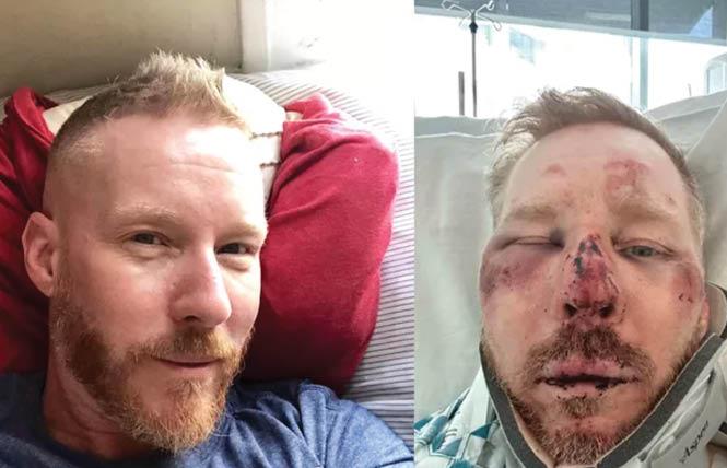 Barry Miles, left, before he said he was attacked by two men, and right, after he was hospitalized. Photos: Via GoFundMe